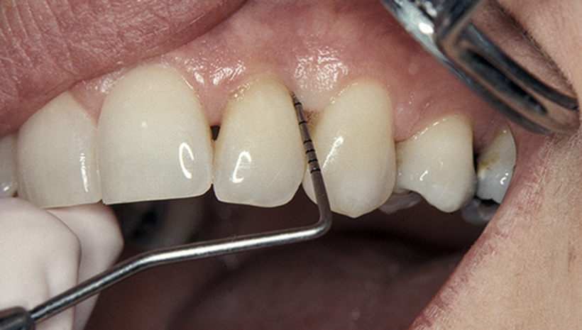 Endodontic treatment